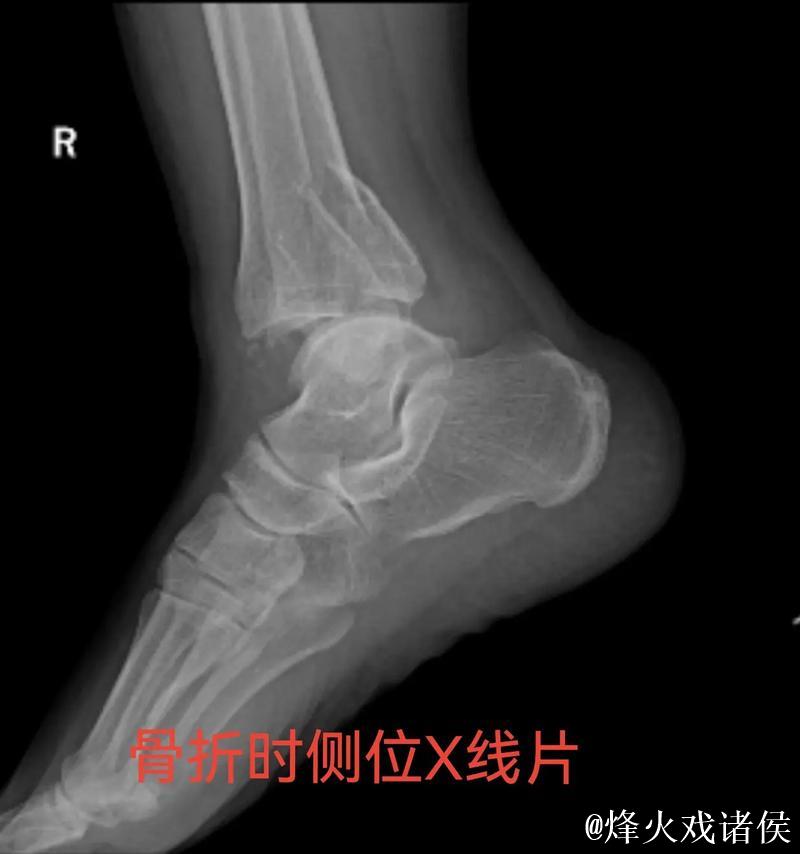 林孝天重伤！右踝三角韧带断裂 右侧腓骨骨折