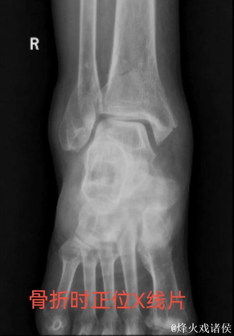 林孝天重伤！右踝三角韧带断裂 右侧腓骨骨折